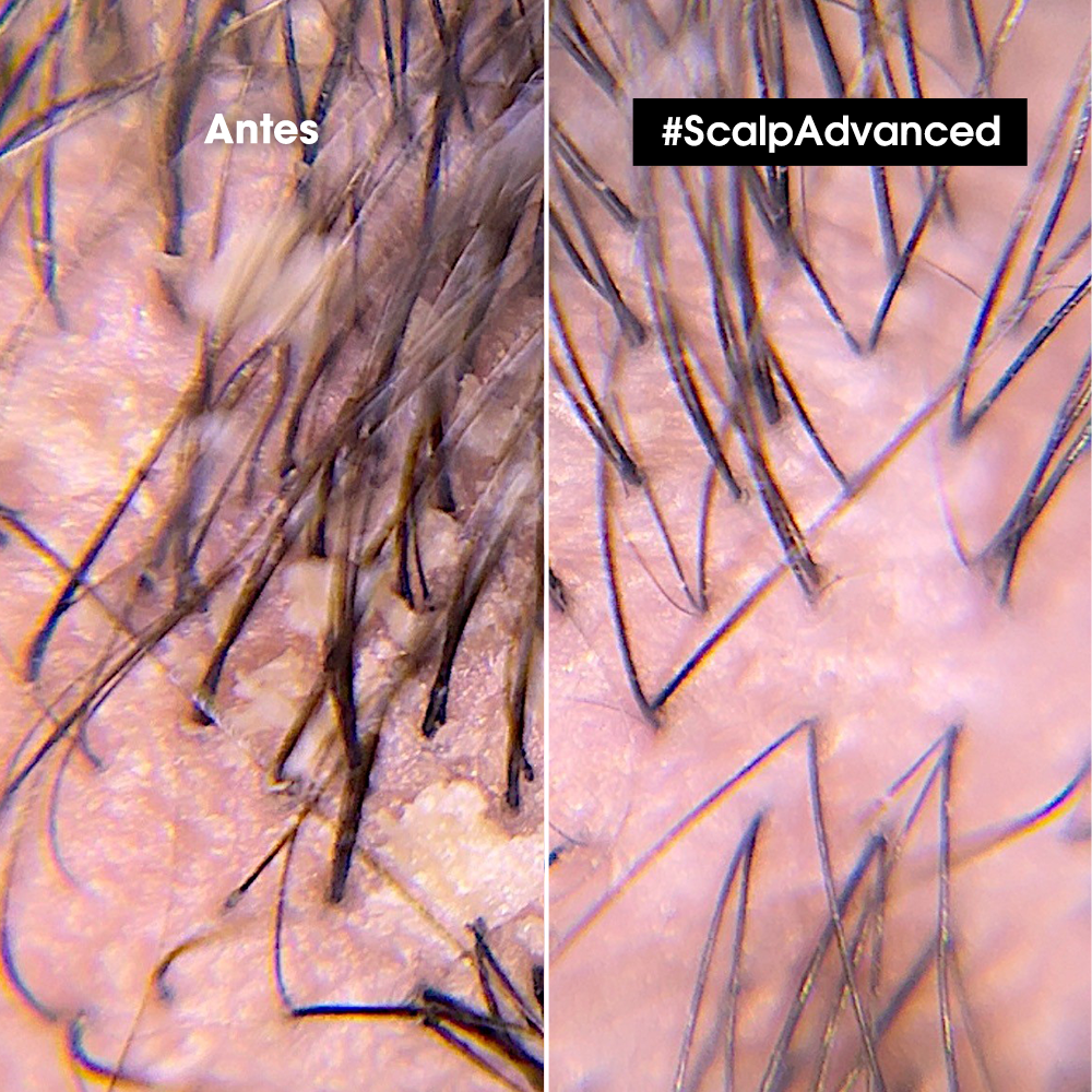 Shampoo Anti-Caspa Scalp Advanced L’Oreal Serie Expert 300ml - Imagen 4
