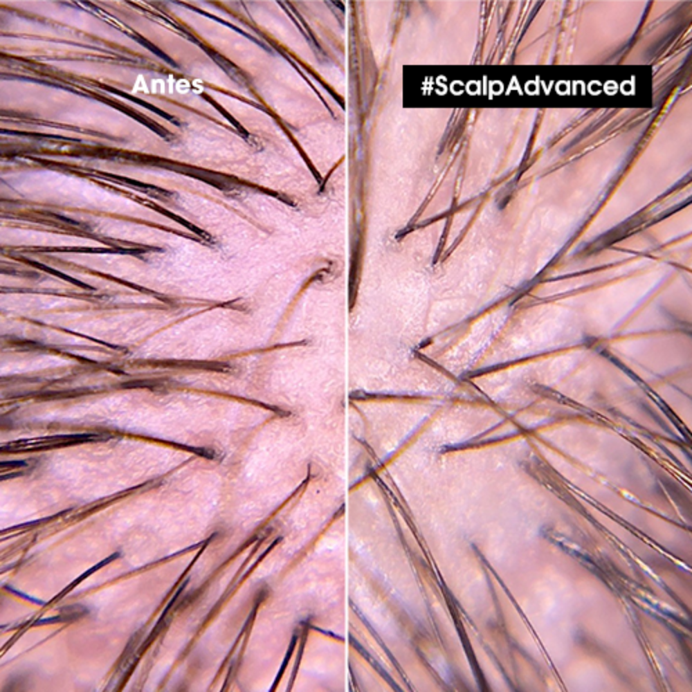 Tratamiento Alivio Intenso Cuero Cabelludo Sensible Scalp Advanced L’Oreal Serie Expert 200ml - Imagen 4